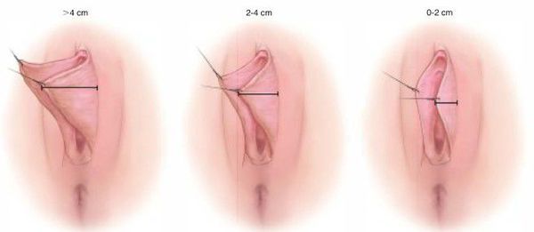 Классификация выпячивания половых губ
