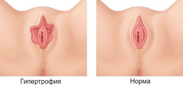 Малые половые губы: гипертрофия и норма
