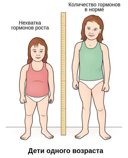 Дефицит гормона роста