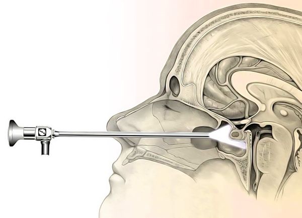 Транссфеноидальная резекция гипофиза Транссфеноидальная резекция гипофиза