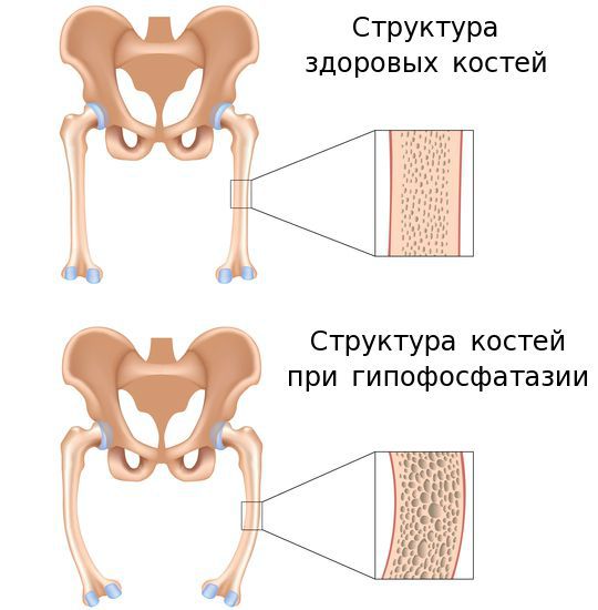 Структура костей здорового человека и больного гипофосфатазией