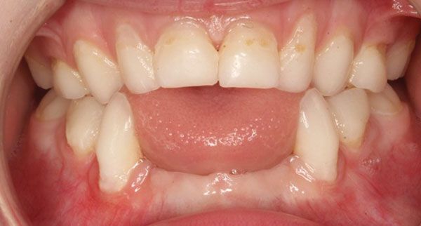 Выпадение зубов при гипофосфатазии