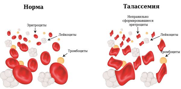 Эритроциты в норме и при талассемии