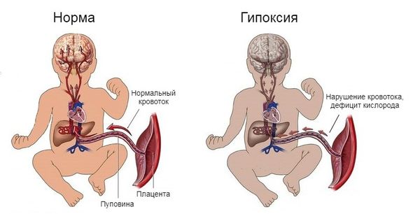 Гипоксия в родах. Помощь остеопата