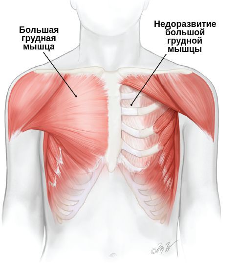 Недоразвитие большой грудной мышцы