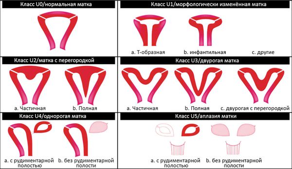 Лечение гипоплазии матки