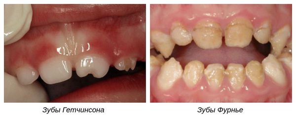Гипоплазия молочных зубов фото