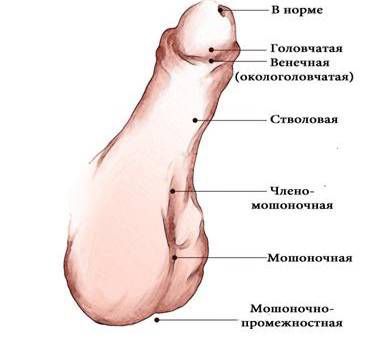 Исправление кривизны полового члена