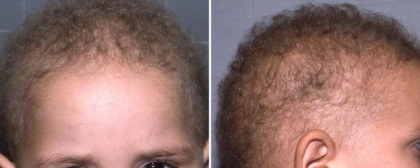 Гипотрихоз [13]