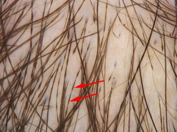 Псевдомонилетрикс [14]