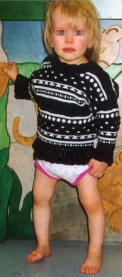 Рахит у ребёнка [15]