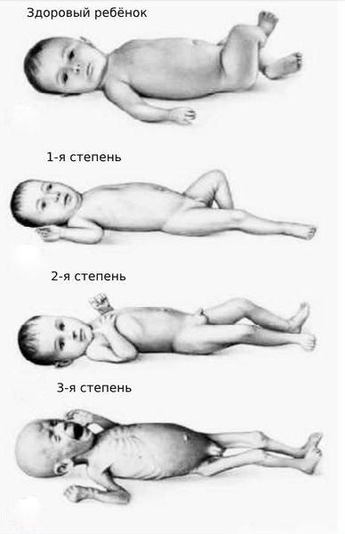Степени гипотрофии по степени стяжести