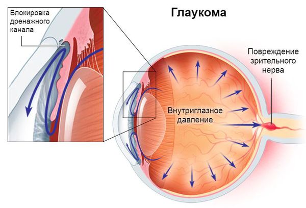 Характерные нарушения при глаукоме