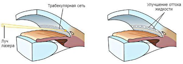 Схема выполнения лазерной трабекулопластики