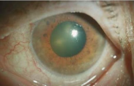Зелёный оттенок зрачка приглаукоме [19]