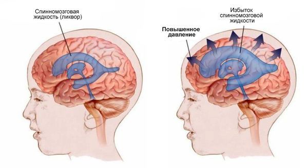 Гидроцефалия и повышение внутричерепного давления