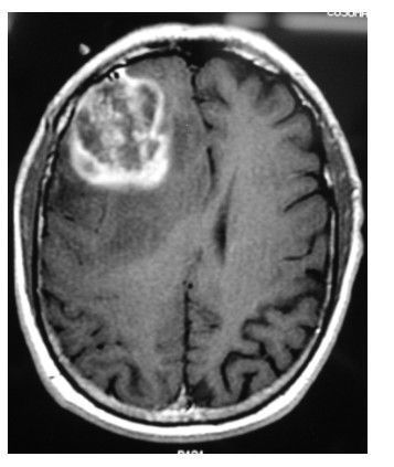 Глиобластома на МРТ [21]
