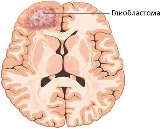 Глиобластома