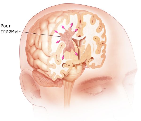 Что такое глиома. Глиальная опухоль головного. Глиома хвостатого ядра.