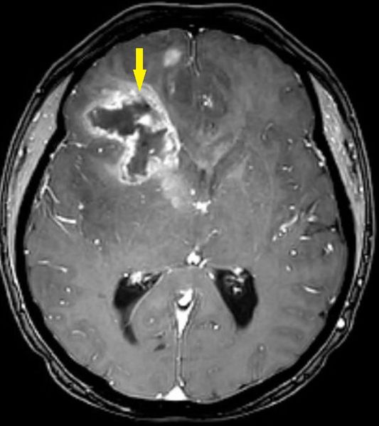 Глиобластома на МРТ головного мозга [14]
