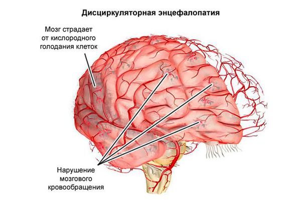 discirkulyatornaya encefalopatiya s
