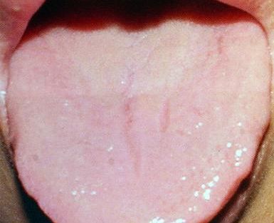 Изменения языка при железодефицитной анемии