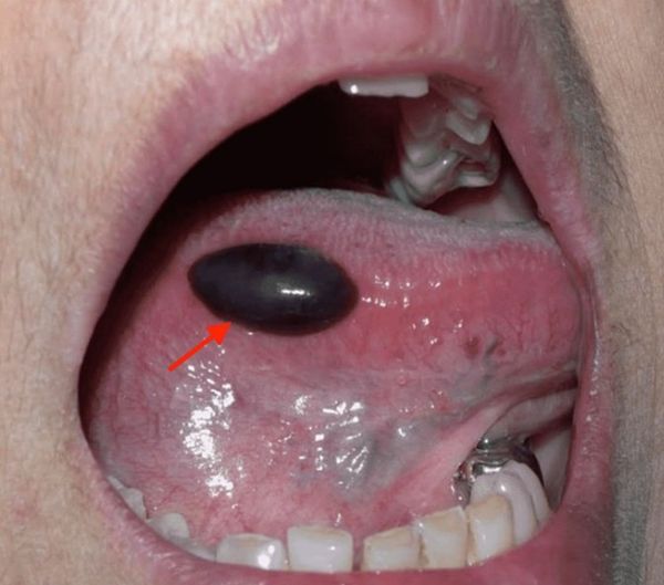 Пузырь с кровянистым содержимым [29]