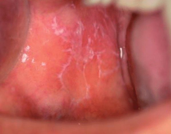 Сетка Уикхема при красном плоском лишае [33]