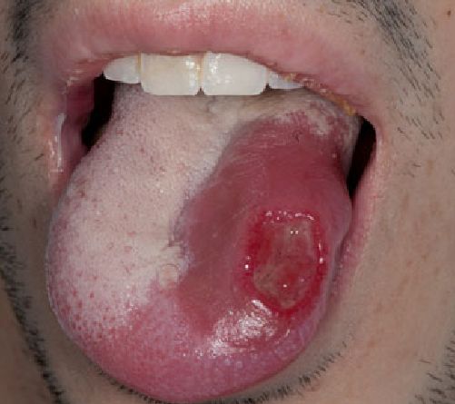 Язык при агранулоцитозе [32]