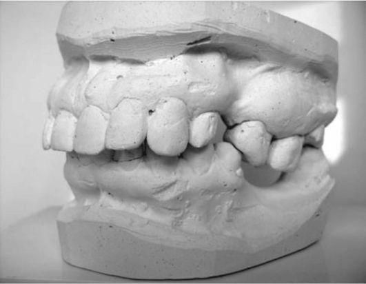 Диагностическая модель челюстей