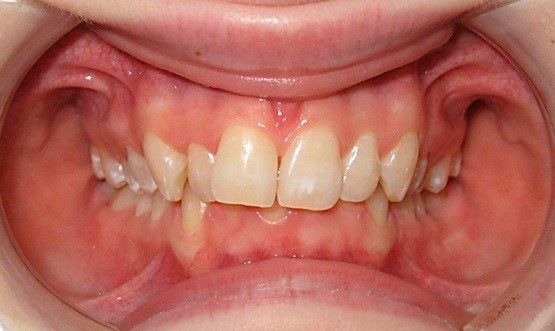 Гиперпрорезывание передних зубов верхней челюсти