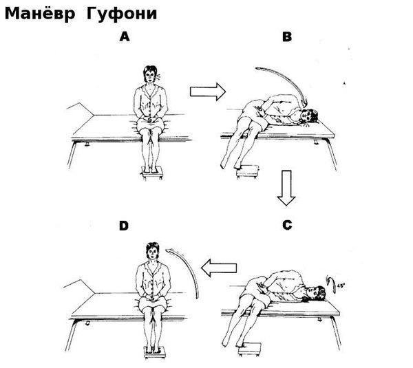 Маневры эпле при головокружении