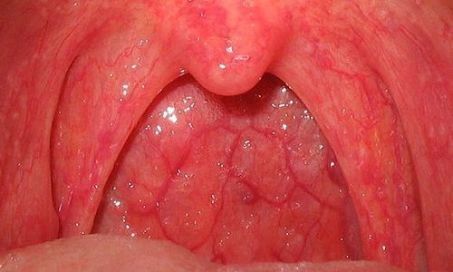 Гиперемия и отёчность слизистой полости рта