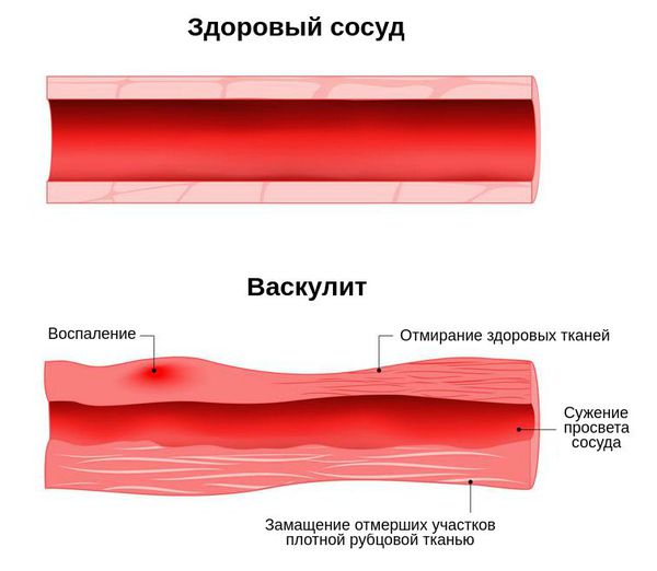 Гранулематоз Вегенера: врачи, клиники, цены | Russian Hospitals