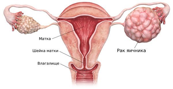 Гранулёзоклеточная опухоль яичника 