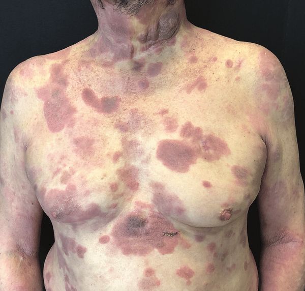 Грибовидный микоз на стадии образования бляшек [19]