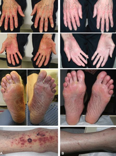 Грибовидный микоз с поражением периферической крови до и после лечения [18]