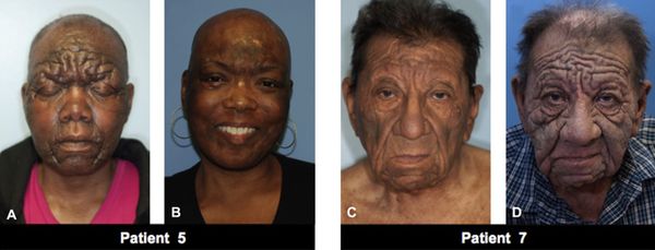 Львиное лицо при грибовидном микозе [20]