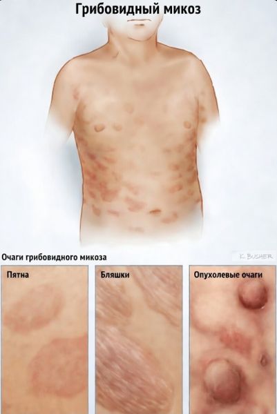 Стадии развития грибовидного микоза