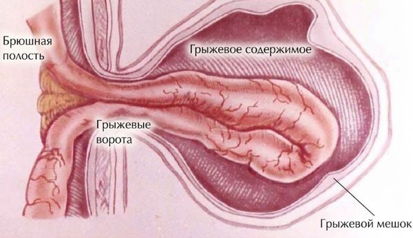 Грыжевые ворота