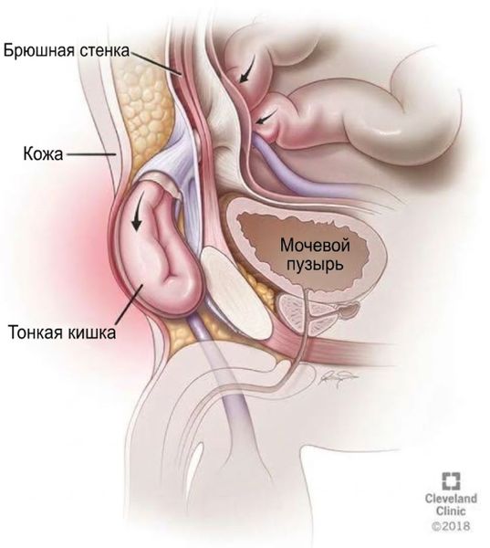 Паховая грыжа