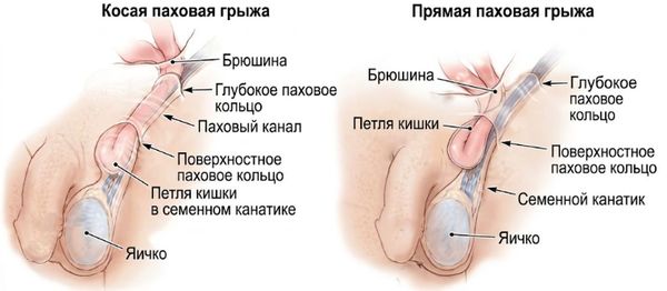 Типы паховых грыж Типы паховых грыж
