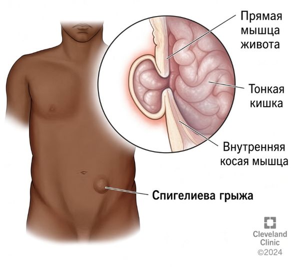 Грыжа спигелиевой линии [15]
