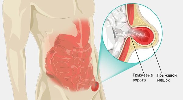 Ущемление грыжи живота