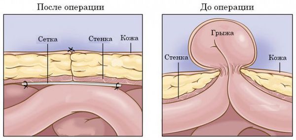 Пластика грыжи с помощью сетки