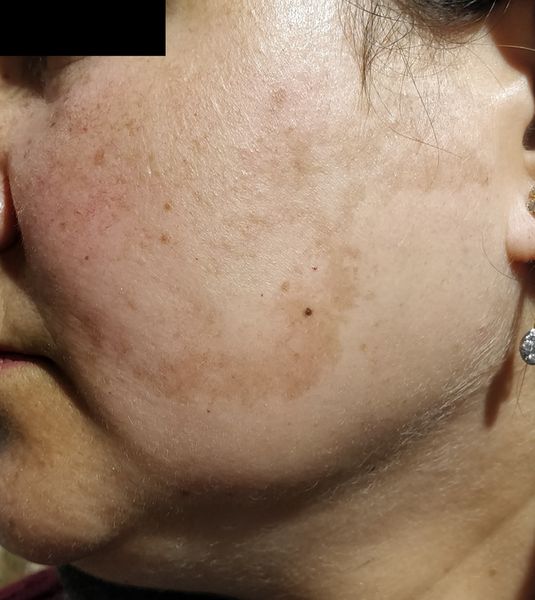 Хлоазма на скулах [37]