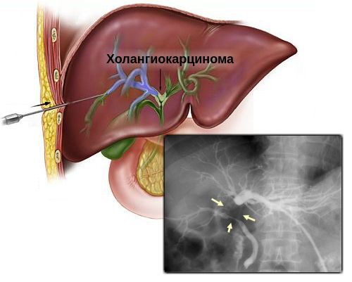 Чрескожная чреспечёночная холангиография: сужение желчного протока из-за опухоли