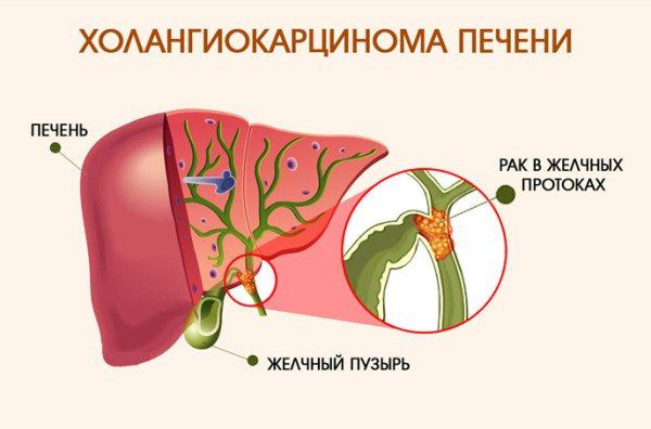 Холангиокарцинома