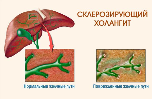 Холангит - причины появления, симптомы заболевания, диагностика и способы лечения