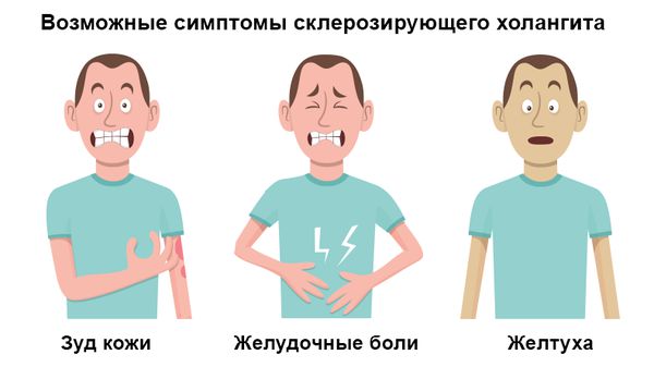 Холангит – причины, симптомы. Методы диагностики лечения различных его видов